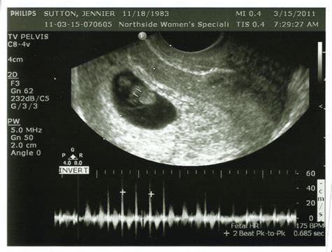 8 Week Ultrasound The Moment Of Truth Robb Sutton