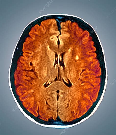 Multiple Sclerosis Mri Brain Scan Stock Image M2100241 Science