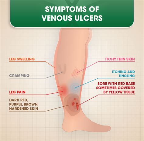 Venous Ulcers Bondi Vein Clinic Varicose Vein Skin Clinic