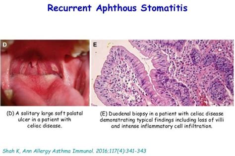 Recurrent Aphthous Stomatitis