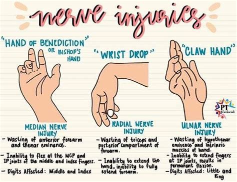 Hand Deformities Of Nerve Injury Medizzy