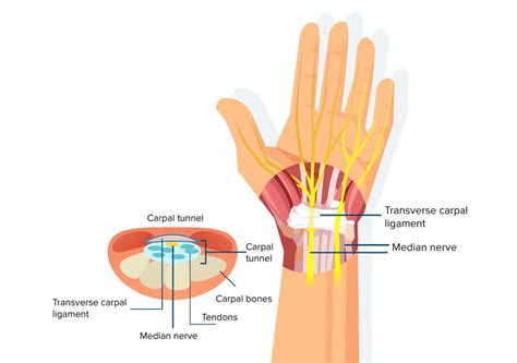 Carpal Tunnel Syndrome Omne Chiropractic