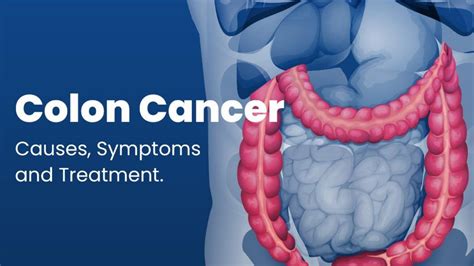 Colon Cancer Causes Symptoms And Treatment Metrohealth Hmo