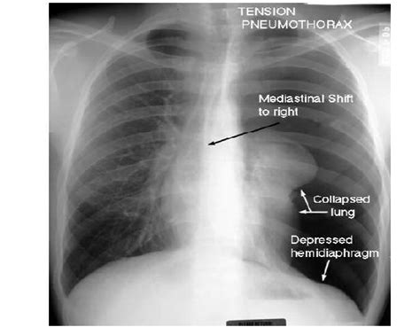 The aim of this study was to identify the risk factors for the development of tension pneumothorax and its effect on clinical outcomes. What is the difference between pneumothorax and tension ...