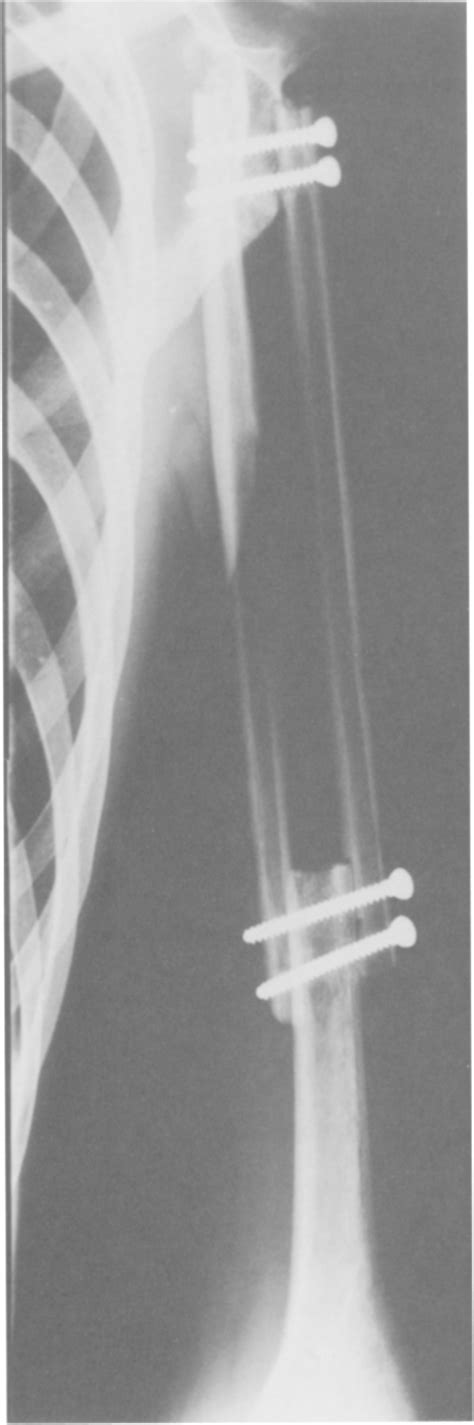 Figure 1 From Resection Arthrodesis Of The Shoulder With Autogenous