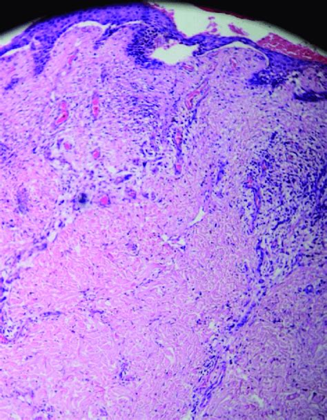 A Skin Biopsy From An Eythematous Papule Showed Spongiotic Epidermis A