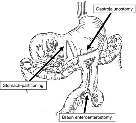 Clinical Impact Of Stomach Partitioning Gastrojejunostomy With Braun
