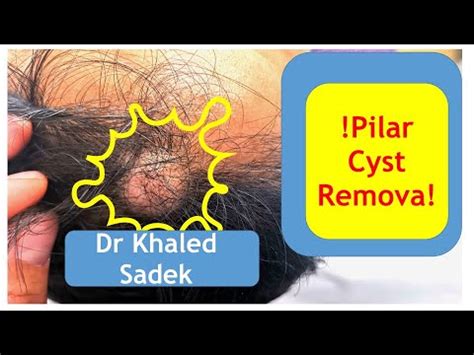 Massive Pilar Cyst Removal Dr Khaled Sadek London Cyst Clinic Behealthy