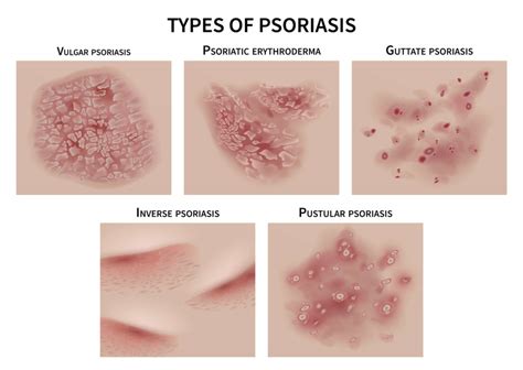 Psoriasis Whats That Itch Yorktest