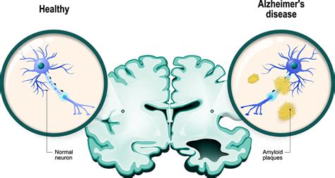 Disruption Of Amyloid β Protein Processing Drives Alzheimers