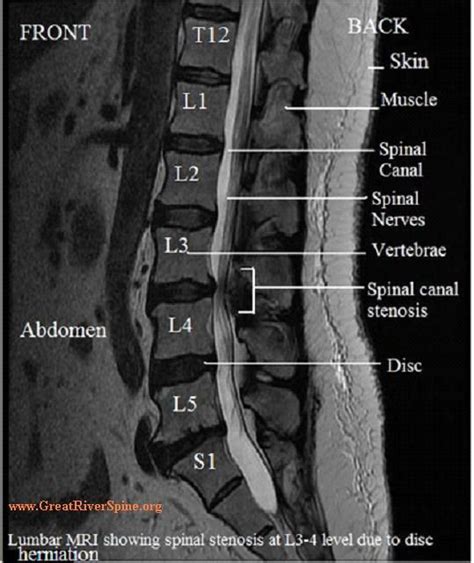 Lumbar Spine MRI Lumbar Spinal Stenosis Mri LSS Pinterest