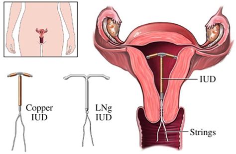 Your Guide To Non Hormonal Birth Control Part 1 The Copper Iud Kendra Perry Nutrition