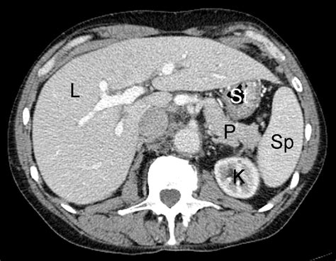 Normal Abdominal Ct Scan Images