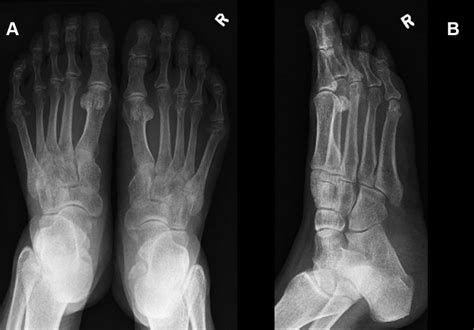 Rheumatoid Arthritis Of Both Feet Note The Small Erosions In The Right