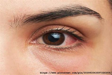 13 Common Causes Of Dark Eyelids And Quick Ways To Get Rid Of It 2023