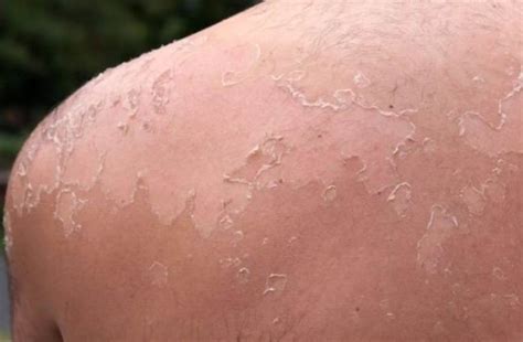 Sunburn Itch Hells Itch Causes Symptoms And How To Get Rid Of It Treat N Heal