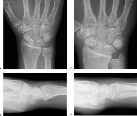 Posterioanterior A And Lateral Radiographs B Of A Typical Patients