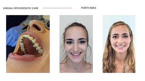 Before And After Orthodontics Modern Orthodontic Clinic In Sammamish