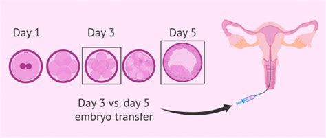 Ivf Embryo Transfer Procedure Definition Process And Tips
