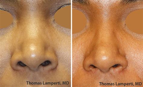 Wide Bridge Rhinoplasty In Seattle Rhinoplasty Surgeon