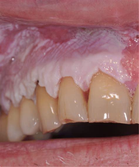 Diode Laser Surgery In The Treatment Of Oral Proliferative Verrucous