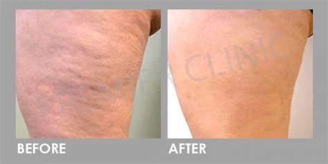 shockwave therapy cellulite reduction treatment premier clinic