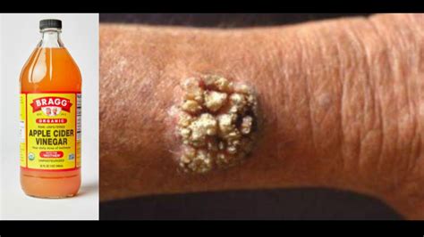 WART REMOVAL APPLE CIDER VINEGAR The Methods That Have Ever Actually Worked For Me YouTube