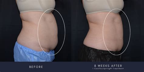 Want To Get Your Coolsculpting® Elite Results Faster Here S How