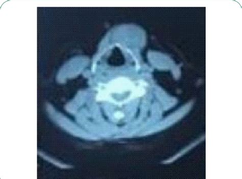 Neck Ct Without Contrast Showing A Mix Lesion Left Anterior Hyoid Bone
