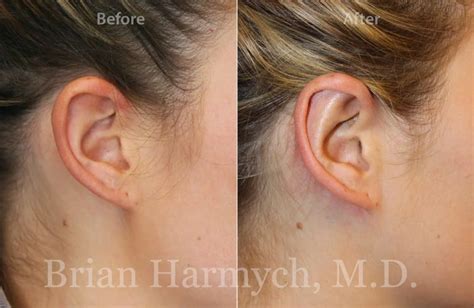 Otoplasty Ear Pinning Cleveland Ohio Dr Harmych