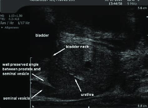 Prostate Ultrasound Anatomy