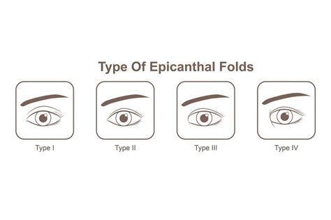 Epicanthic Fold Causes Characteristics And Corrections Dream Plastic Surgery