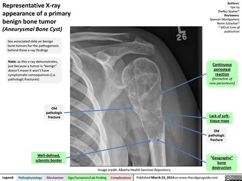 Representative X Ray Appearance Of A Primary Benign Bone Tumor