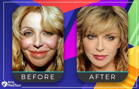 Celebs Who Admitted They Got Nose Job Ariamedtour