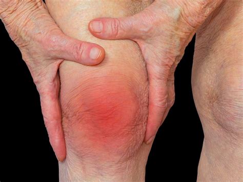 Arthritis And Rheumatism Whats The Difference