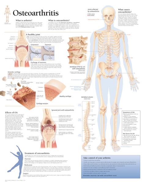 Osteoarthritis Anatomy Chart Clinical Charts And Supplies