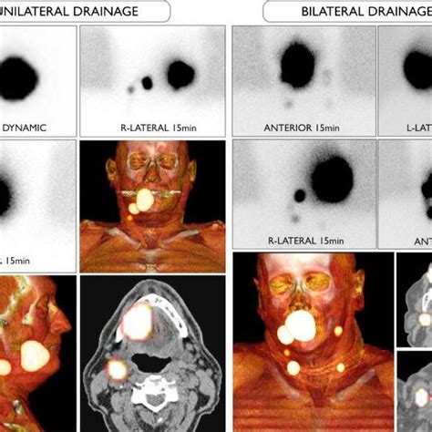 Lymphoscintigraphy Sentinel Node Mapping Lymphatic Drainage To The