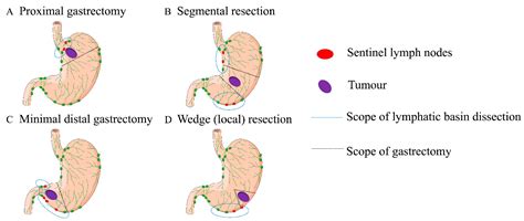 Cancers Free Full Text Mapping Lymph Node During Indocyanine Green