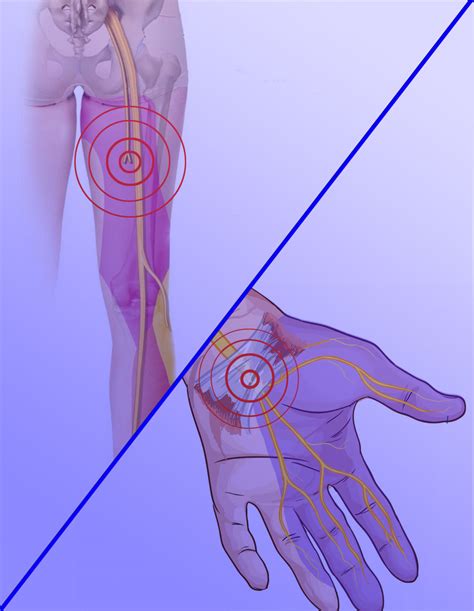 Neuromuscular Massage Therapy Triangle Point Therapy