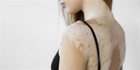 Vitiligo Sun Luis Obispo Ca Coastal Dermatology Aesthetics