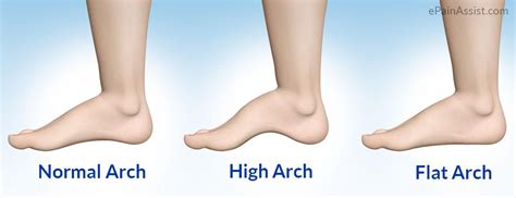 You have any tingling or loss of sensation in your foot. Flat feet vs High foot arch - Mandurah Physiotherapy