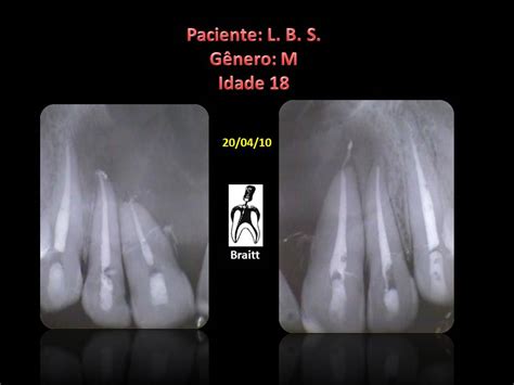 Endodontia Dr Henrique Braitt Tratamento Endod Ntico De Grande Les O No Periodonto Apical