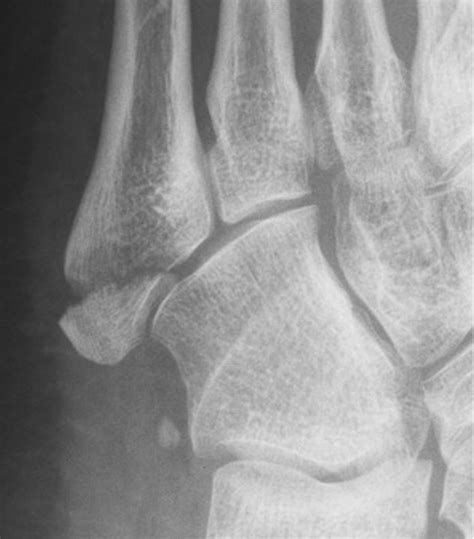 Symptomatic Treatment Or Cast Immobilisation For Avulsion Fractures Of The Base Of The Fifth