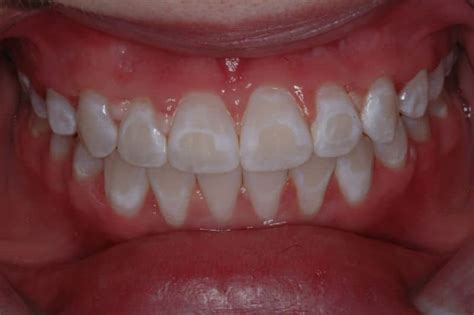 Teeth Treat How To Prevent White Spots On Teeth After Braces