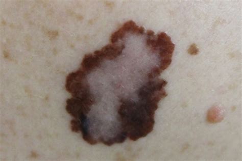 Redheads Melanoma Risk Can Be Reduced By Altering Specific Protein