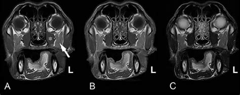 Magnetic Resonance Images At The Level Of The Zygomatic Salivary Gland