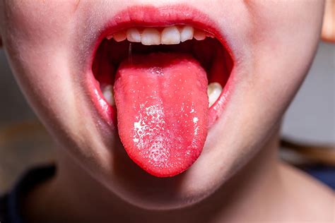 Morango Língua Saúde Sistêmica Influências Que Esta Condição De Saúde Oral Good Mood
