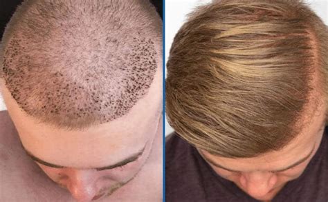 The Best Hair Transplant In Albania Results Before And After Is It Worth It For You Techplanet