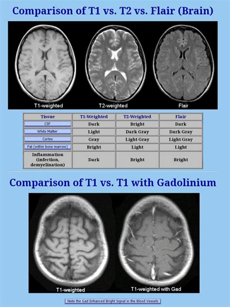 What Is T1 And T2 Mri