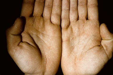 Dry Eczema On Hands Pictures 475 Photos And Images